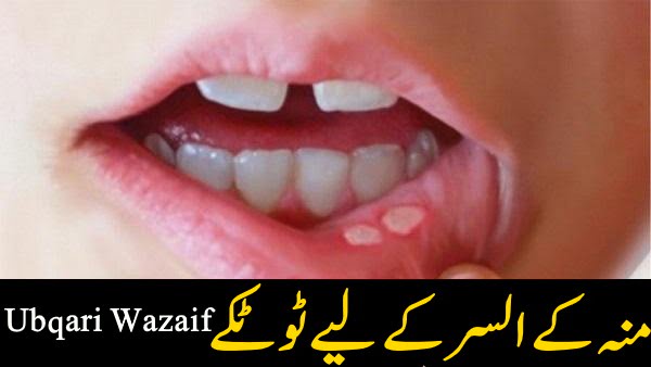 Totkay for Mouth Ulcer | Moun Ke Chale Ka Ilaj in Urdu | Mouth Blisters Treatment in Urdu - Ubqari Totkay