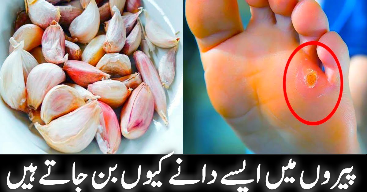 What should you do if you have pimples under your feet? Home Remedies For Feet