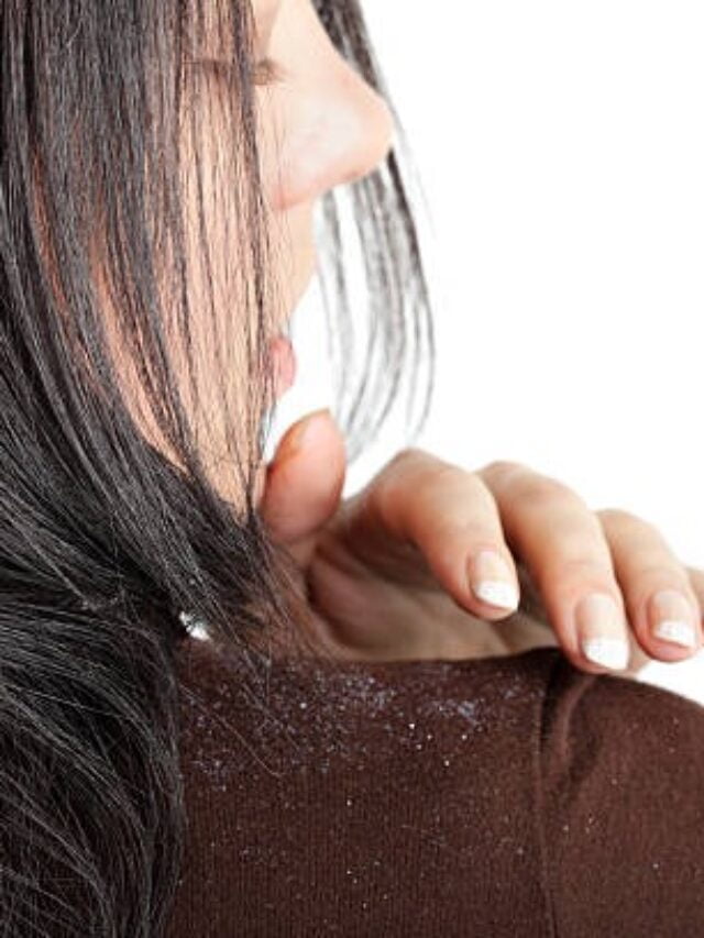 10 Home Remedies to Get Rid of Dandruff Naturally